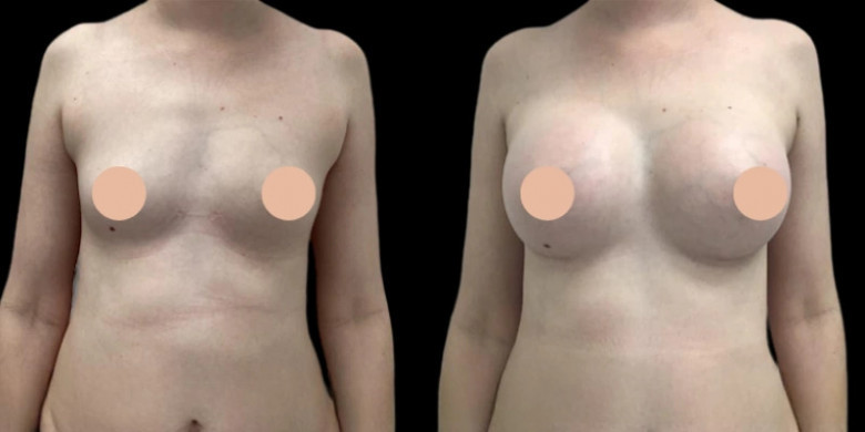 Breast Augmentation in Dubai: From Consultation to Recovery