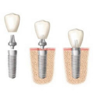 toothimplantsydney