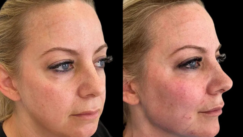 Beginner’s Guide to Cheek Fillers by the Best Aesthetic Clinic in Dubai