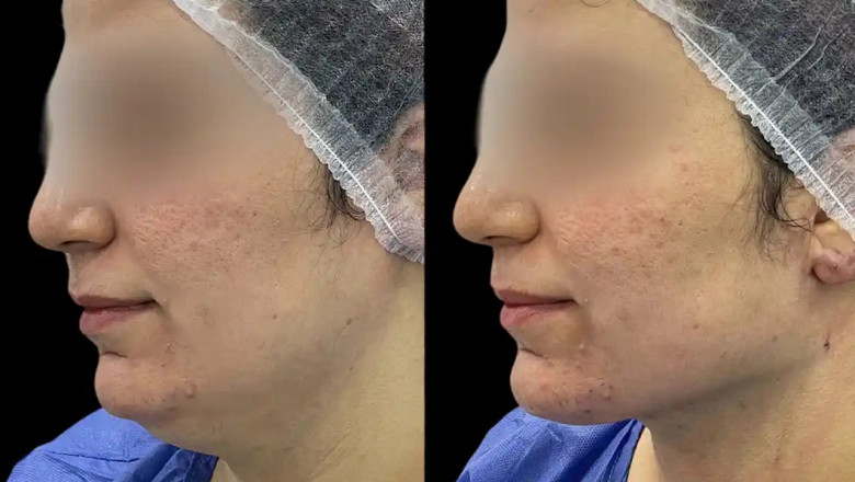 Enhance Your Appearance with Chin Fillers in Dubai
