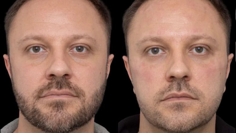 How Under Eye Fillers in Dubai Can Improve Your Overall Look