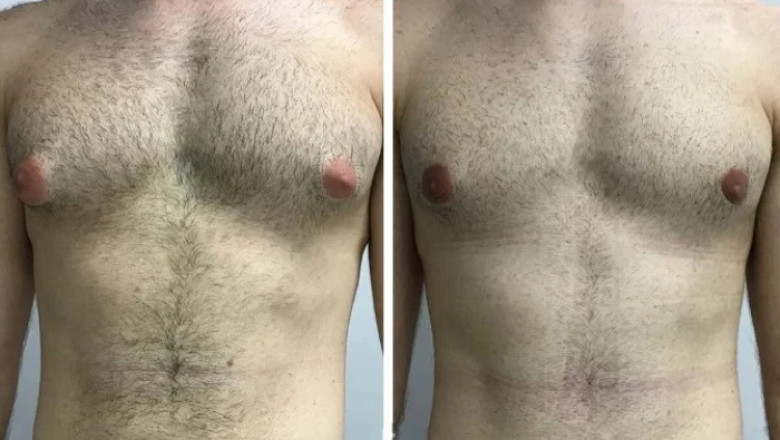 Top 5 Best Gynecomastia Surgeons in Dubai for Male Breast Reduction