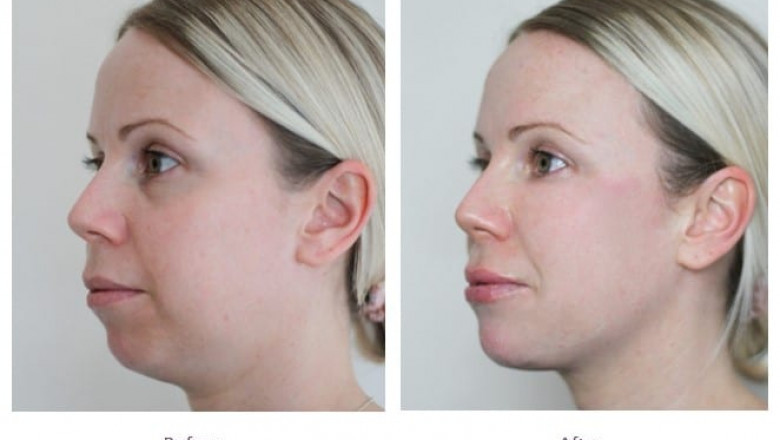 Understanding the Ingredients Used in Jawline Fillers in Dubai