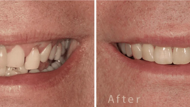 Dental Implant Aberdeen: A Simple Guide to a Better Smile