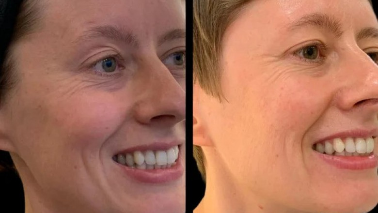 The Best Doctors in Dubai for Anti-Aging Profhilo Treatments What You Need to Know