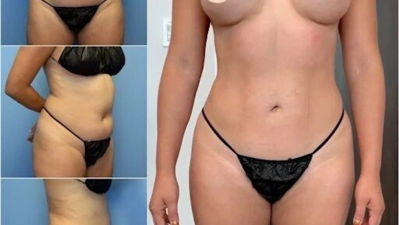 Body Contouring in Dubai: Fast Results, Long-Term Satisfaction