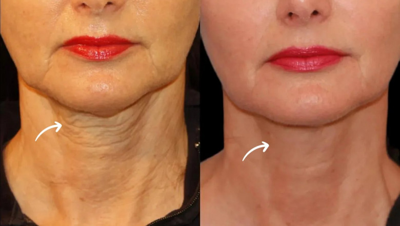 Best Plastic Surgeon in Dubai Talks About Sculptra Fillers for Wrinkle Reduction
