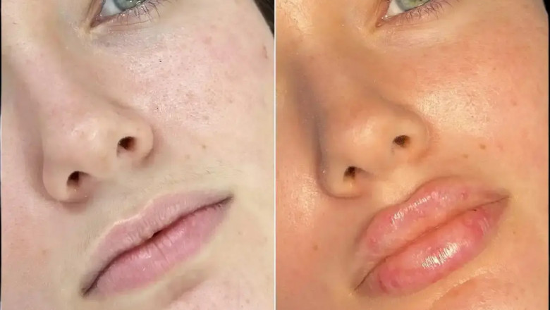 Best Doctors in Dubai for Fillers with Advanced Techniques