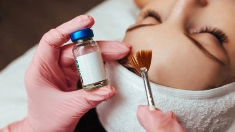 Can You Get a Chemical Peel with Active Acne?