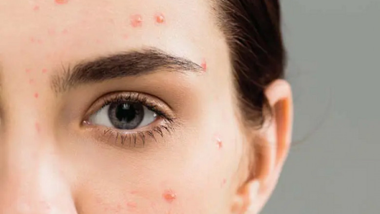 Acne Treatment With Minimal Side Effects