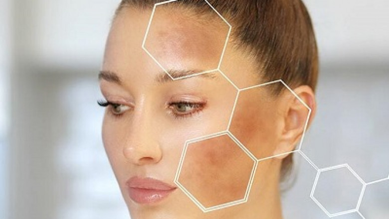 Can Men Get Melasma? Treatment Insights from Islamabad Clinics
