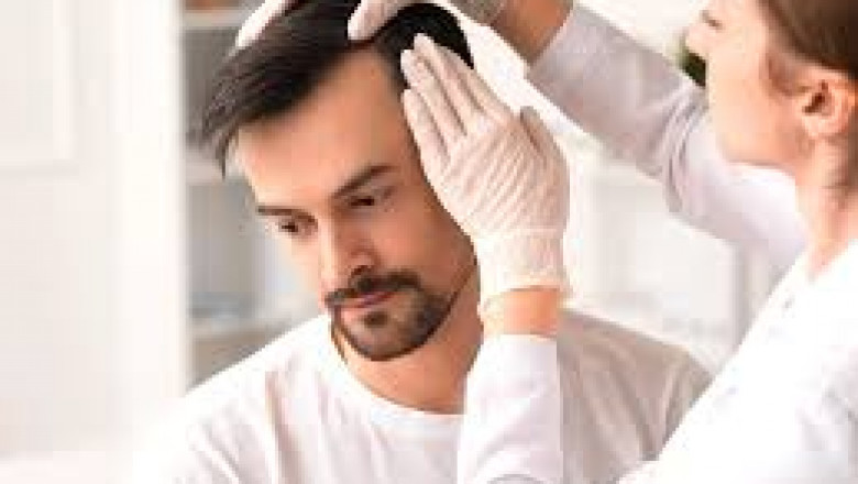Is It Possible to Have a Second Hair Transplant?