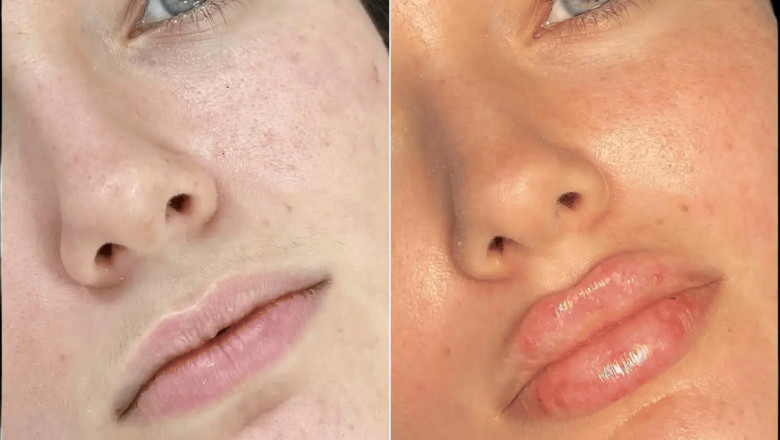 Best Plastic Surgeons in Dubai for Fillers: Enhance Your Natural Beauty