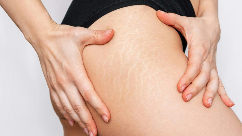 Can Men Get Stretch Marks Too?