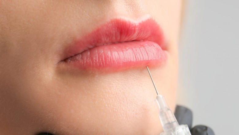 Can Older Women Benefit from Lip Fillers? Absolutely—Here’s How