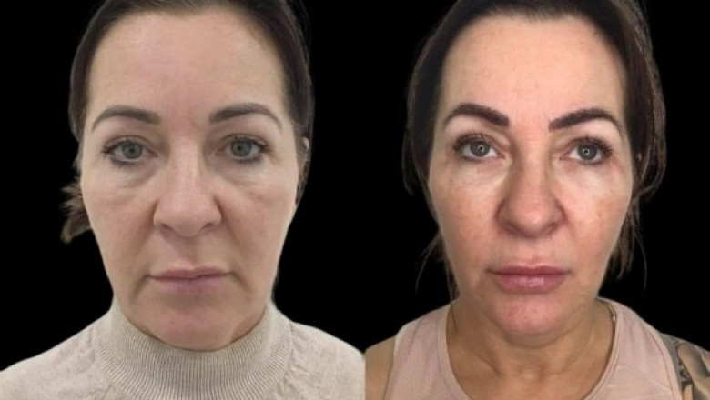 Define Natural Beauty with Profhilo by Best Plastic Surgeons in dubai