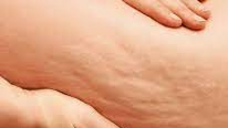 How to Maintain Results After Cellulite Treatment?