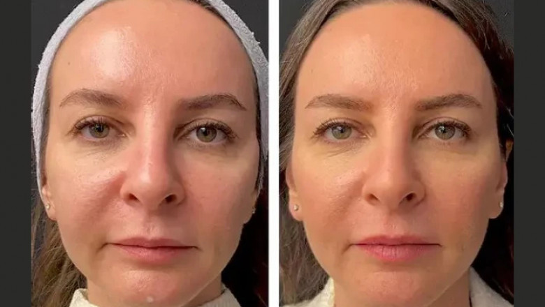 Before and After Results of Mesotherapy Treatments in Dubai