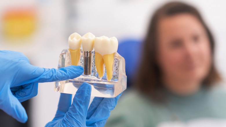 How Long Should You Wait After Tooth Extraction to Get Implants?