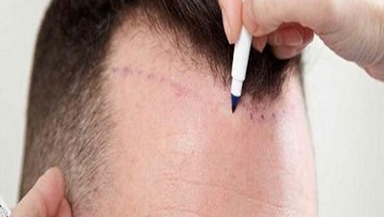 Discover Natural Results with Hair Transplant in Islamabad