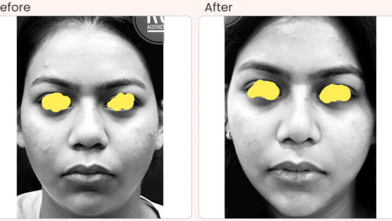 Buccal Pad Fat Removal Cost In Delhi - Dr Rajat Gupta