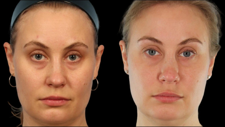 How the Best Doctors in Dubai Help You Look Rested and Refreshed with Under Eye Fillers
