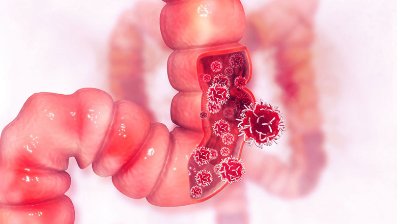 Metastatic Colorectal Cancer Market Poised to Surge with Novel Immunotherapies