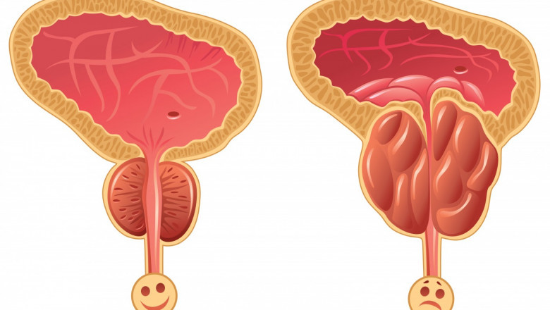 Neuroendocrine Prostate Cancer Market to Soar Owing to Targeted Therapy Innovations