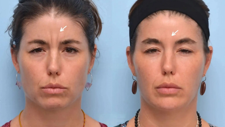 Best Aesthetic Clinic in Dubai: The Role of Experienced Botox Injectors in Achieving Natural Results