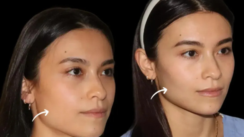 Cost vs Results in Dubai’s Best Aesthetic Clinic: Are Sculptra Fillers Worth It?