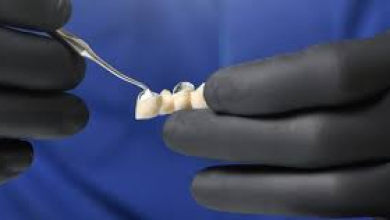 Temporary vs. Permanent Dental Cement