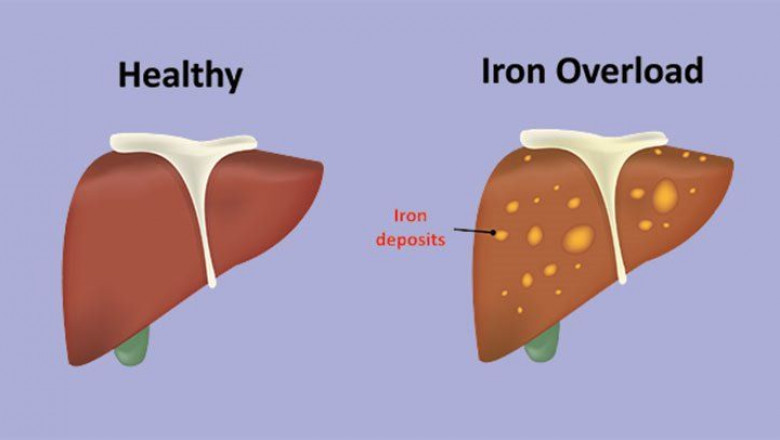 When Too Much Iron Isn’t So Strong: A Real Talk About Iron Overload