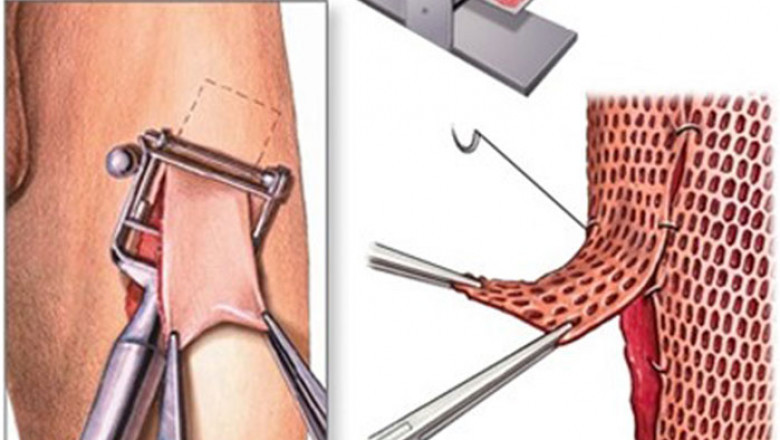 Global Skin Grafting Device Market Grows Rapidly Owing to Regenerative Therapies