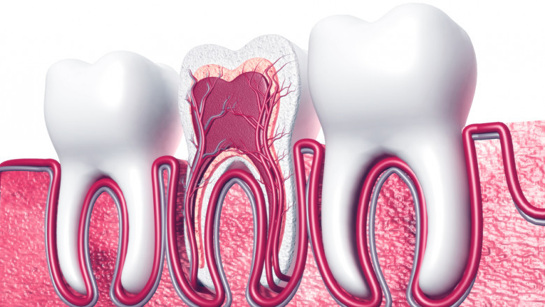 Wedding Season in Islamabad: Fix Your Smile with Root Canal Treatment