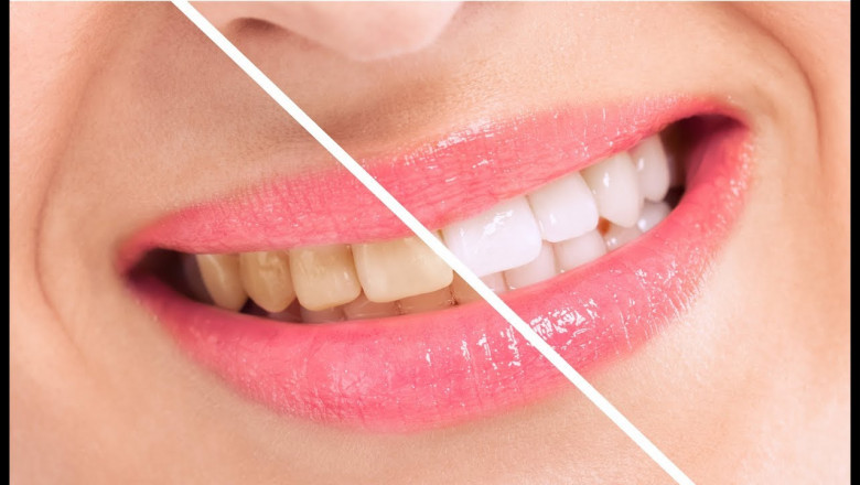 Get White Teeth Naturally at Home Easy Ways to Get White Teeth Without Chemicals