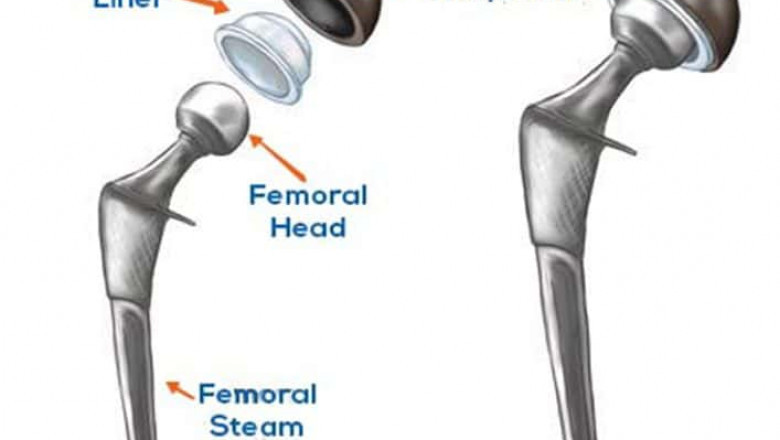 Rediscover Mobility with Joint Replacement Surgery in Ludhiana – Here’s What You Need to Know!