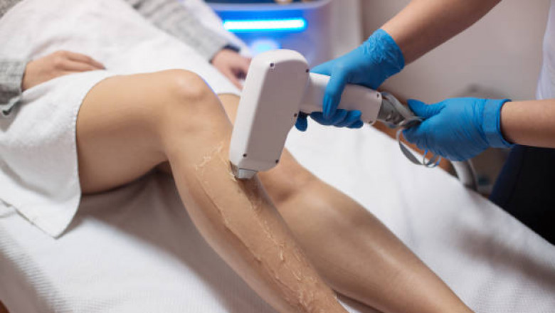The Ultimate Guide to Laser Hair Removal Toronto: What You Need to Know