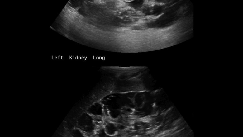 Autosomal Dominant Polycystic Kidney Disease Market to Surge on Biologic Therapies