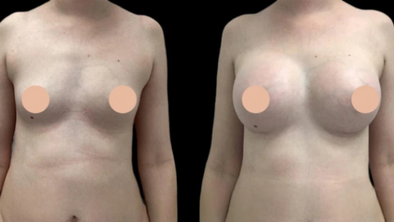 Breast Augmentation in Dubai: From Consultation to Recovery