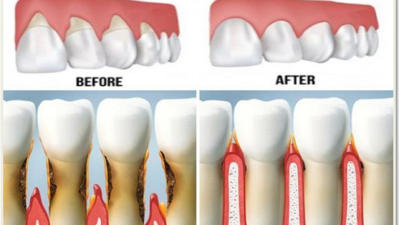 Gingival Recession Market to grow owing to implant adoption