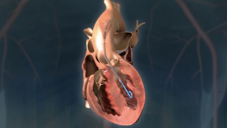 Heart Pump Device Market To Grow on Minimally Invasive Technology