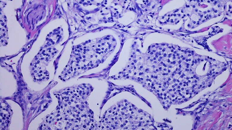 Neuroendocrine Tumors Market to Grow Fastest with Targeted Therapies