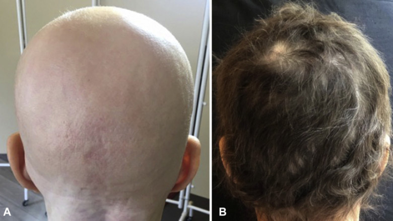 Alopecia Areata Treatment Market Will Surge Owing to Biologic Innovations