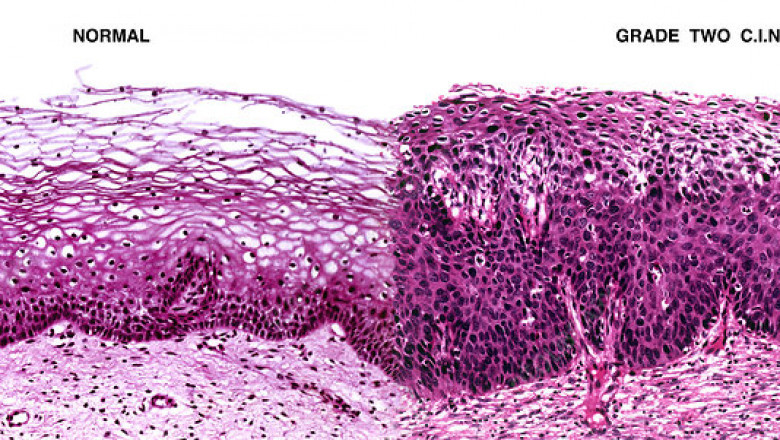Cervical Intraepithelial Neoplasia Market will grow at highest pace owing to non-invasive diagnostic innovations