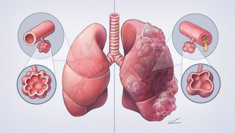 COPD Treatment Market Estimated to Grow with Digital Inhalers
