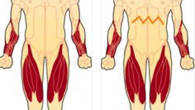 Inclusion Body Myositis Market to Grow Rapidly Owing to Novel Immunotherapy Advances