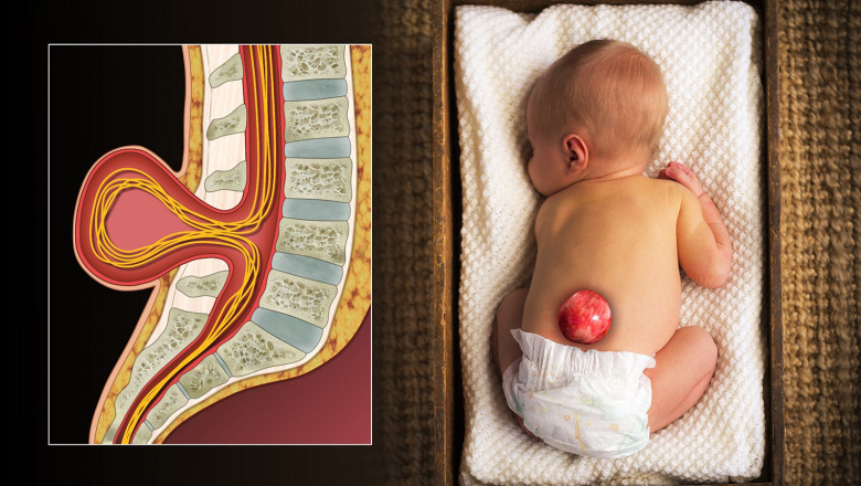Spina Bifida In-Utero Market to Grow Highest Owing to Rising Fetal Surgery Adoption