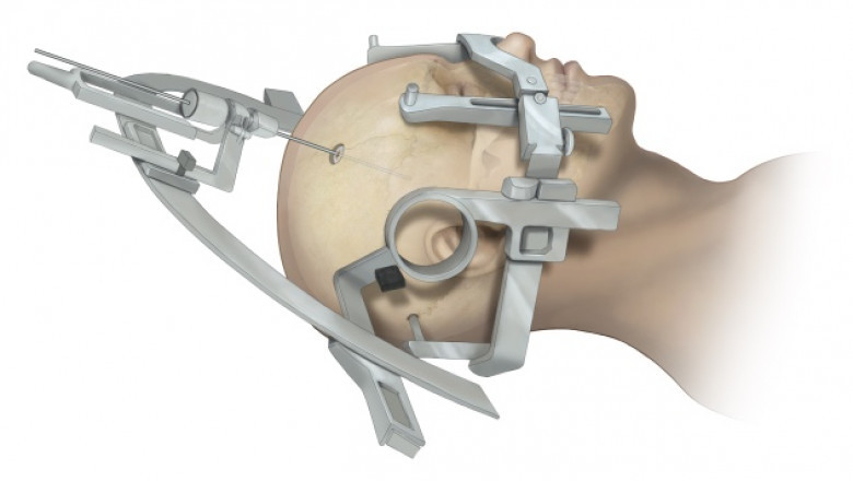 Stereotactic Surgery Devices Market to Soar with AI Integration