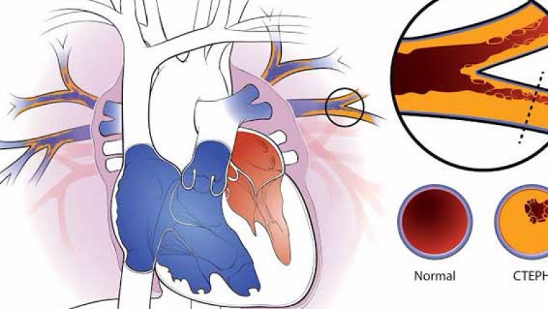 Chronic Thromboembolic Pulmonary Hypertension (CTEPH) Market Growth Trends