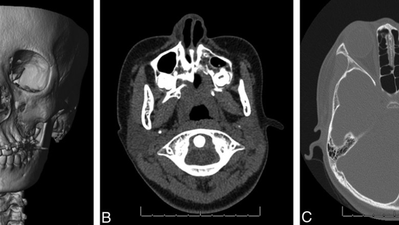 Parry Romberg Syndrome Market Growth and Revenue Trends